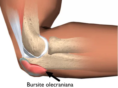 Bursite olecraniana