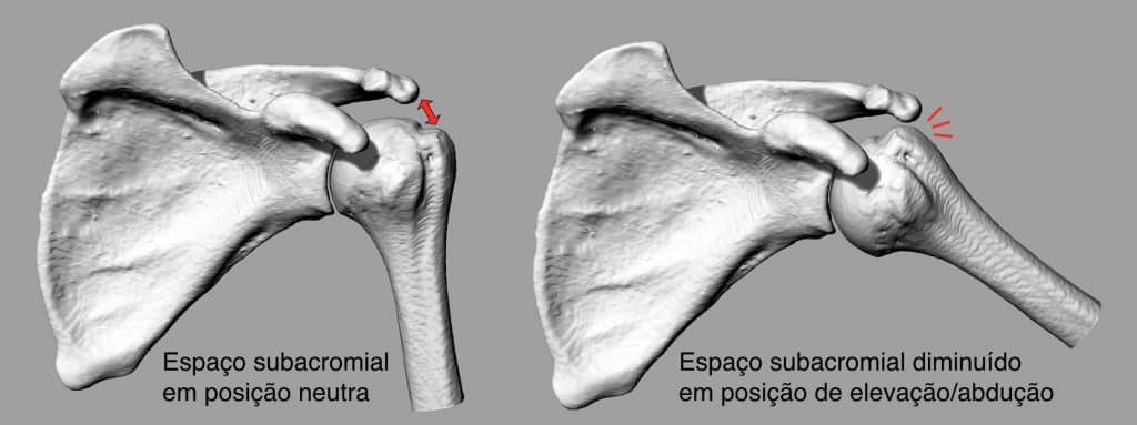 Síndrome de impacto de ombro